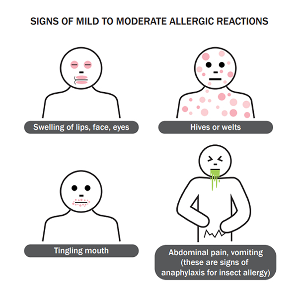 What Are The Signs And Symptoms Of Allergic Reaction? – Dane101