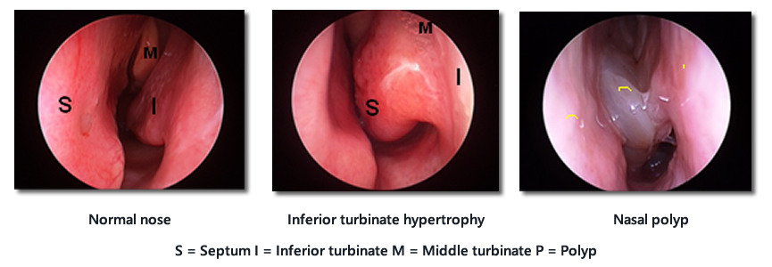 Normal nose inferior turbinate hypertrophy and polyp as examined on anterior rhinoscopy