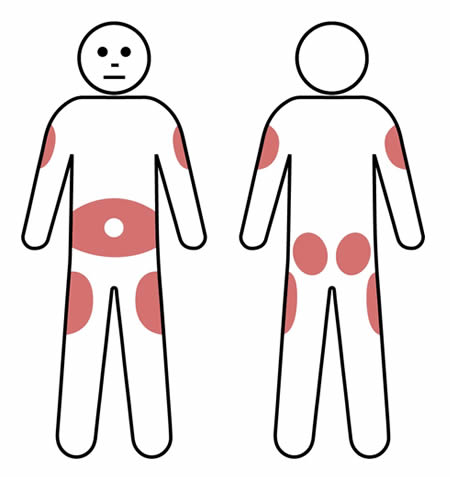 SCIg injection sites