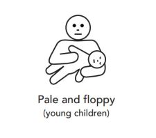 Pale and floppy (young children)