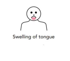 Swelling of tongue